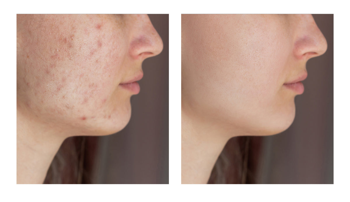 Acne Serum